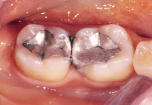 Exemplo amálgamas dentárias