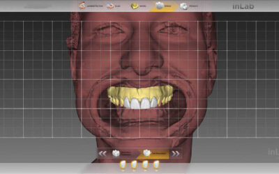 Qual a influência da tecnologia CAD-CAM numa prótese dentária?