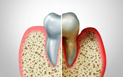 Periodontologia – O que é e qual a importância no tratamento dentário