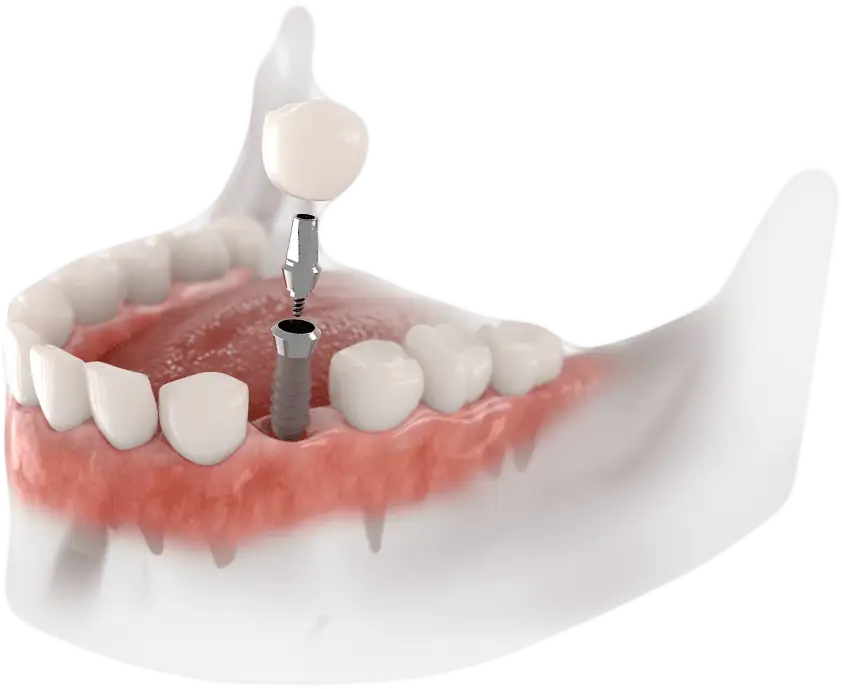 implantes-boca